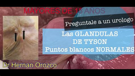 que son las glandulas de tyson|Tyson Glands: What They Are, Causes & How to Get。